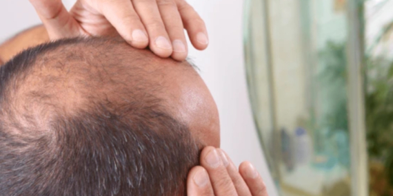 Meslek Seçiminiz Saç Sağlığınızı Etkiliyor